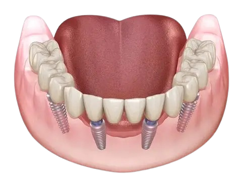 Full Mouth Rehabilitation